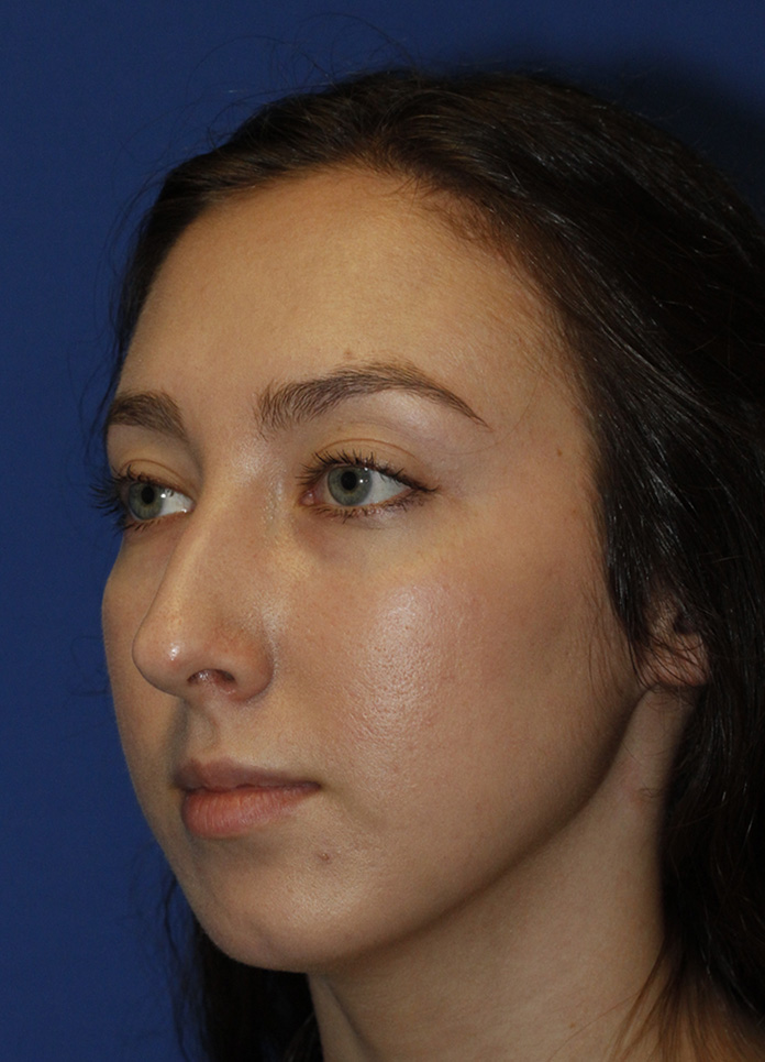 Chin Implant Before L Oblique