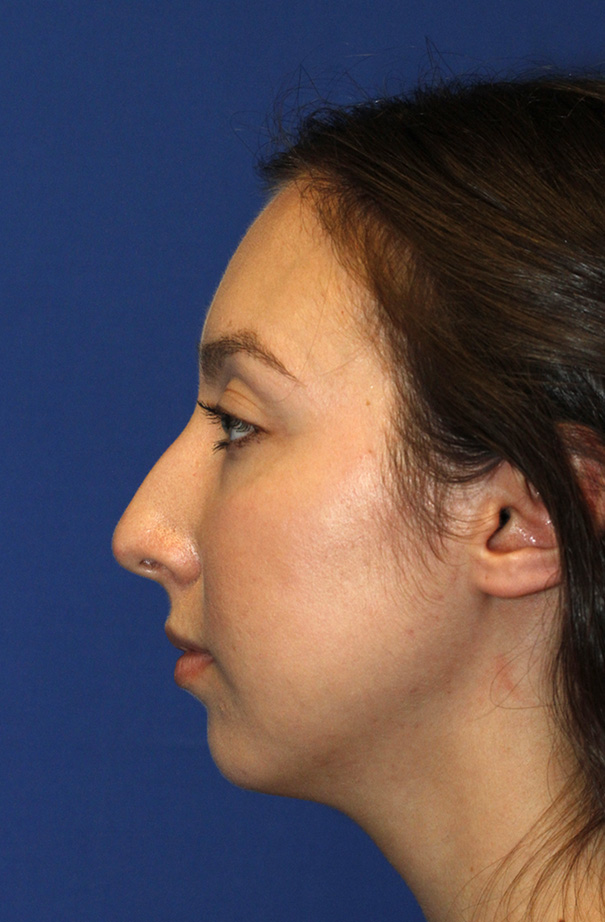 Chin Implant Before L Profile