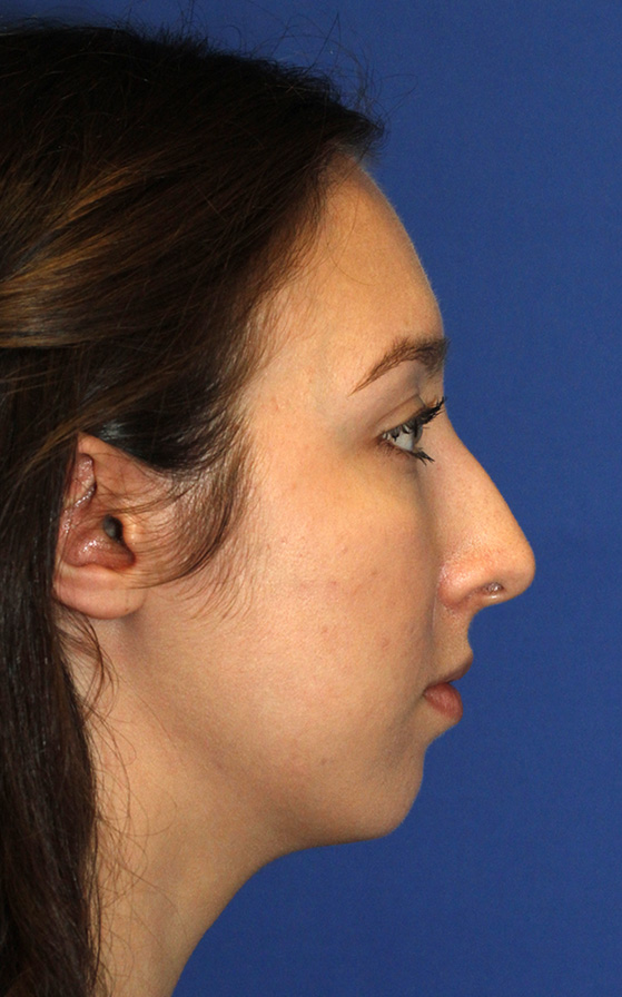 Chin Implant Before R Profile