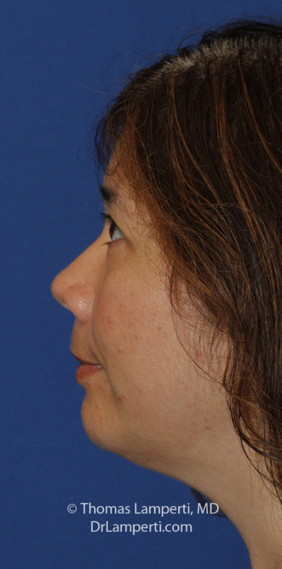 Chin Implant After