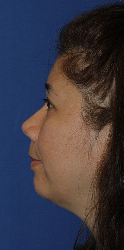 Chin Implant Before