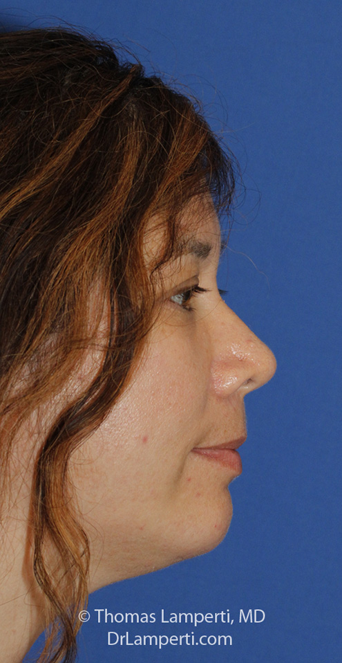 Chin Implant After