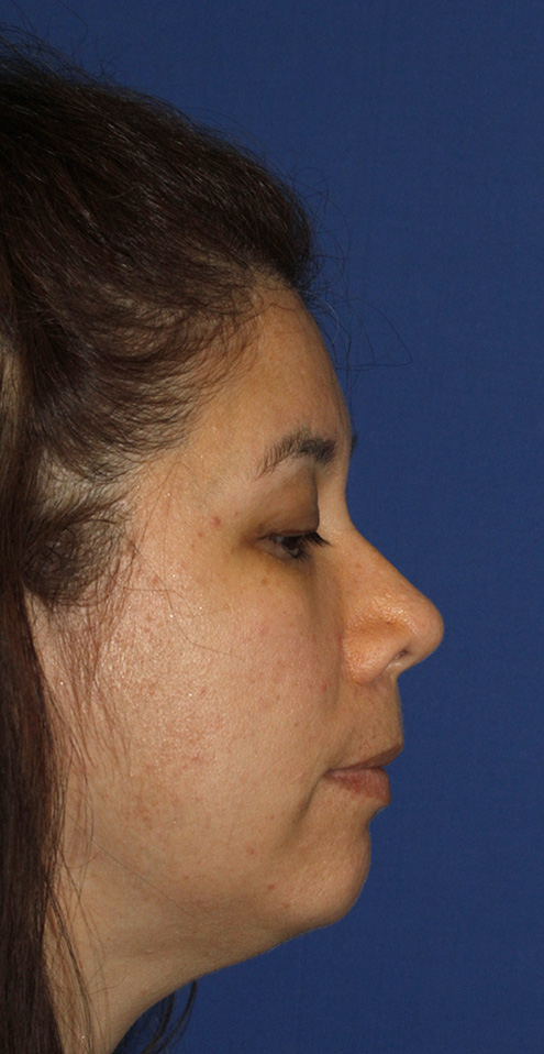 Chin Implant Before