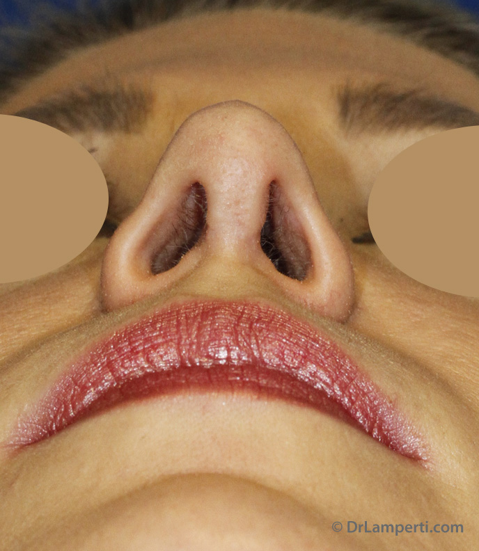 Revision Rhinoplasty After Base