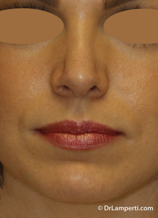 Revision Rhinoplasty After Frontal