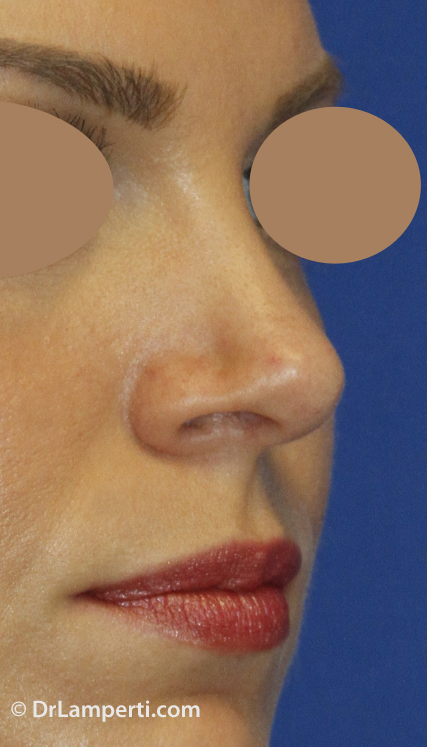 Revision Rhinoplasty After Right Oblique