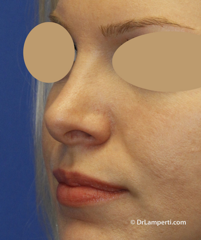 Revision Rhinoplasty Before Left Oblique