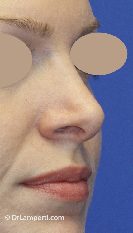 Revision Rhinoplasty Before Right Oblique