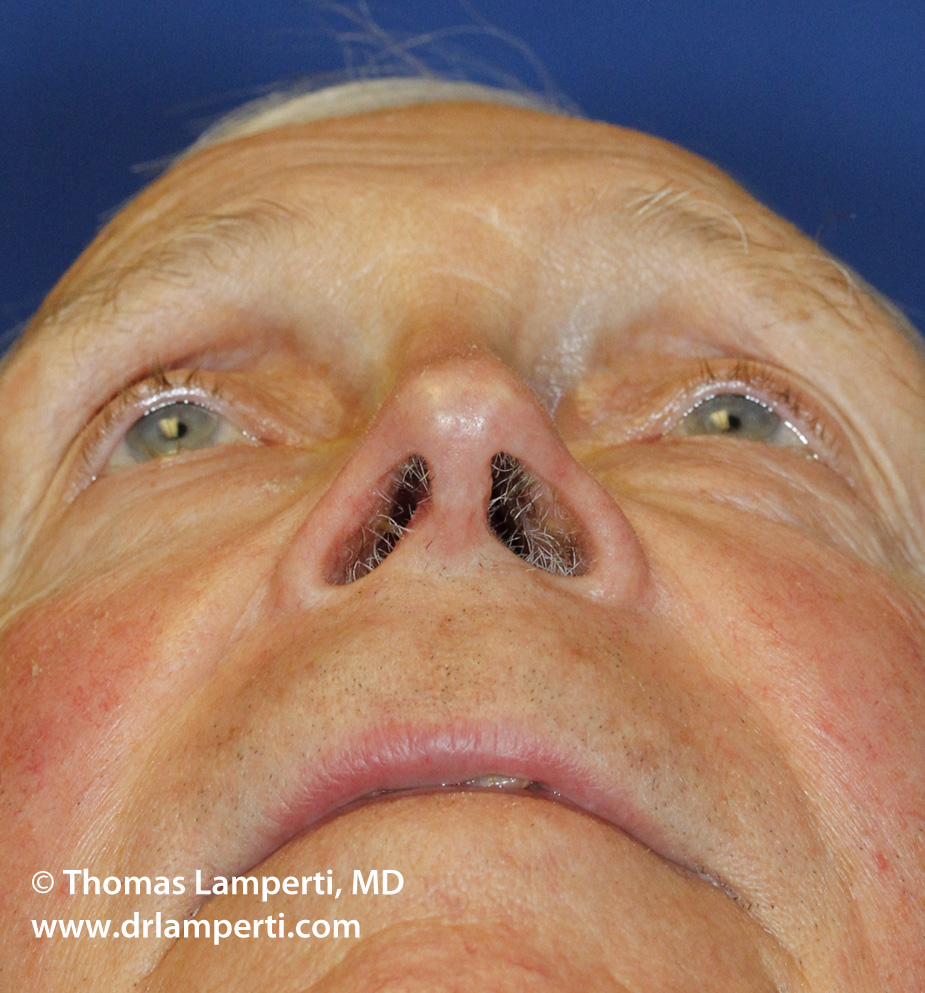 Revision Rhinoplasty Base After