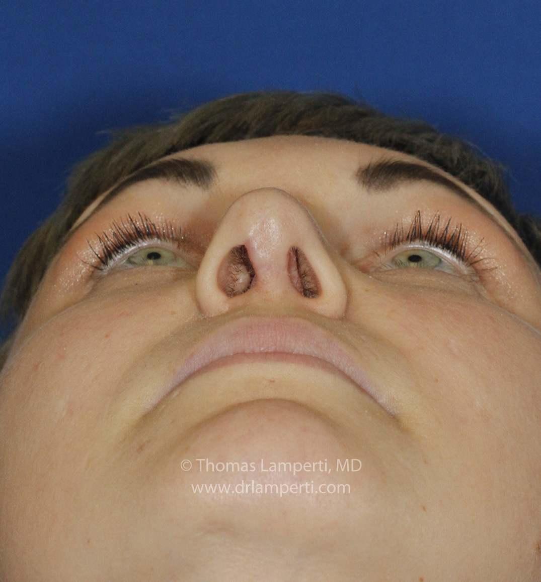 Rhinoplasty After Base