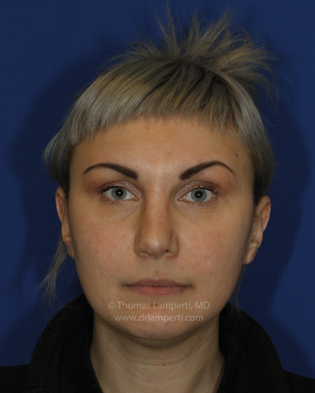 Rhinoplasty After Frontal