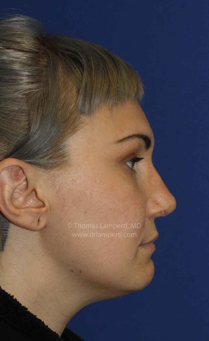 Rhinoplasty After R Profile