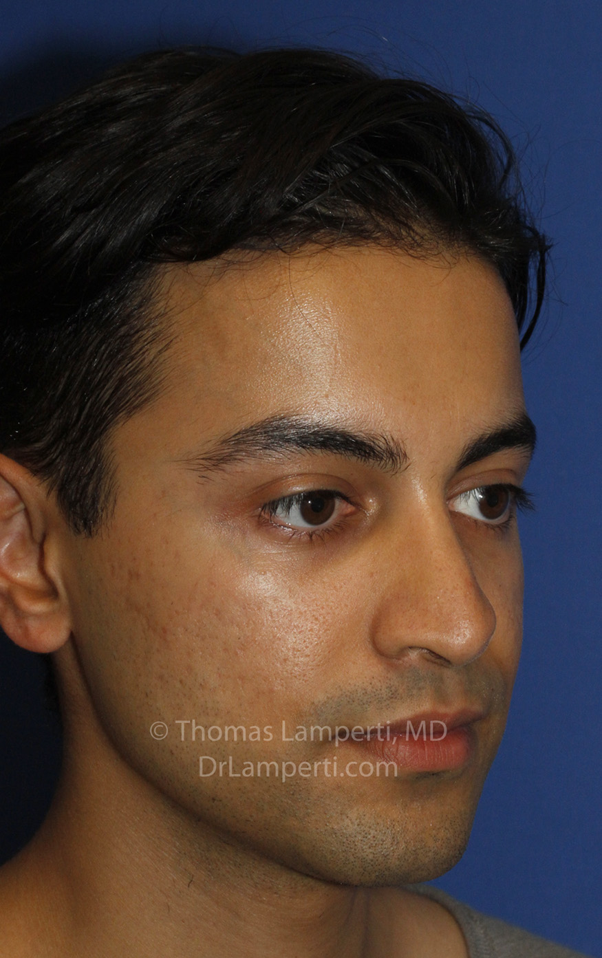 Revision Rhinoplasty After R Oblique