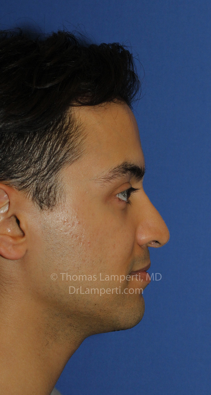 Revision Rhinoplasty After R Profile