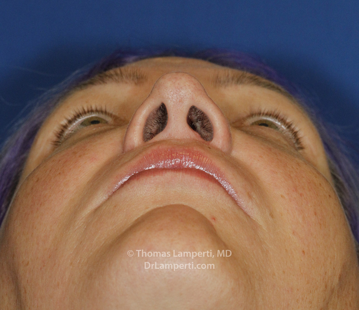 Revision Rhinoplasty After Base