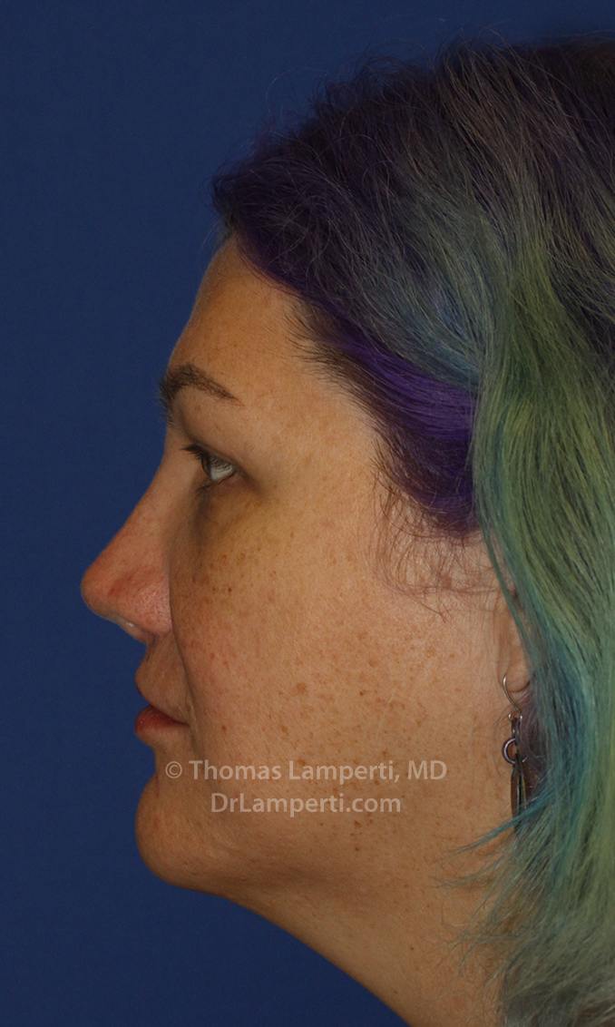 Revision Rhinoplasty After L Profile