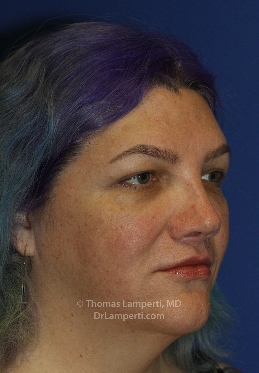 Revision Rhinoplasty After R Oblique