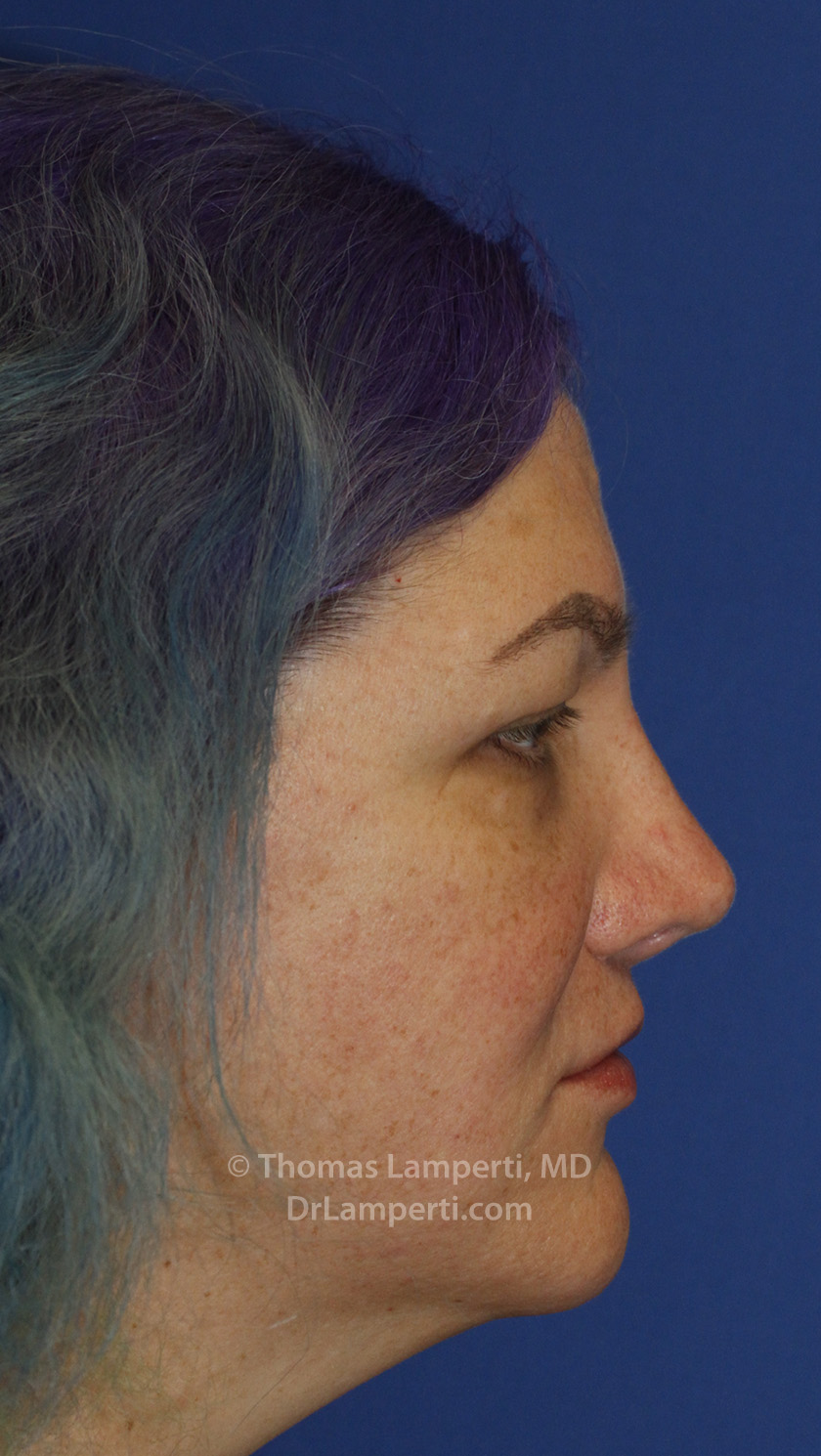 Revision Rhinoplasty After R Profile