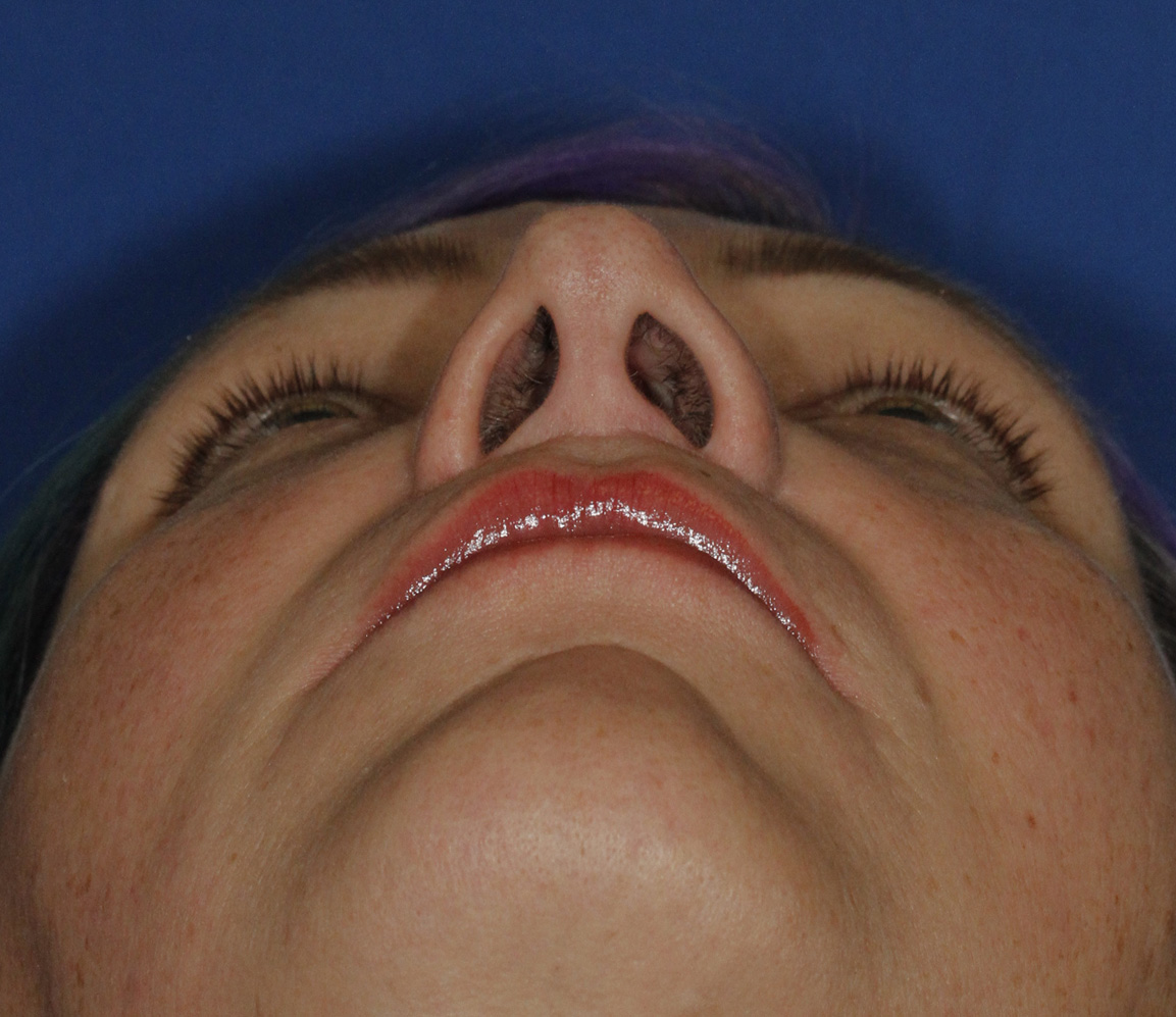 Revision Rhinoplasty Before Base