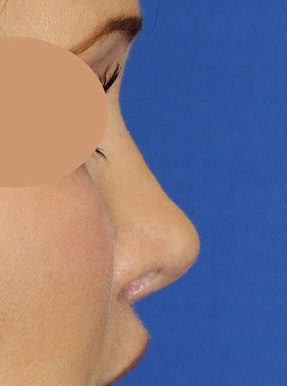 Before Revision Rhinoplasty Right Profile