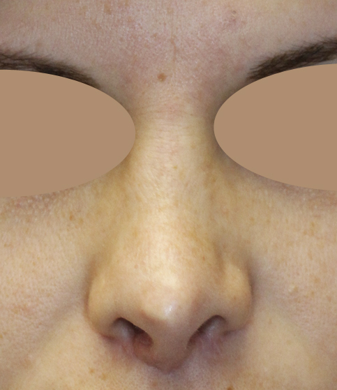 Rhinoplasty Frontal Before