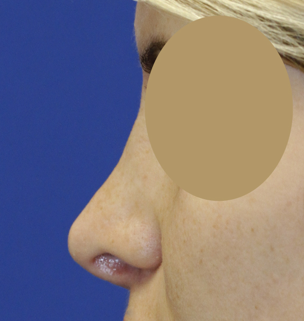 Rhinoplasty L Profile Before