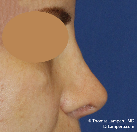 Rhinoplasty R Profile After