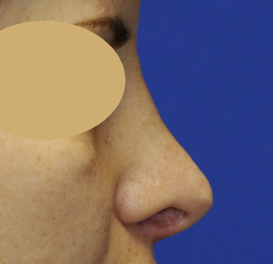 Rhinoplasty R Profile Before