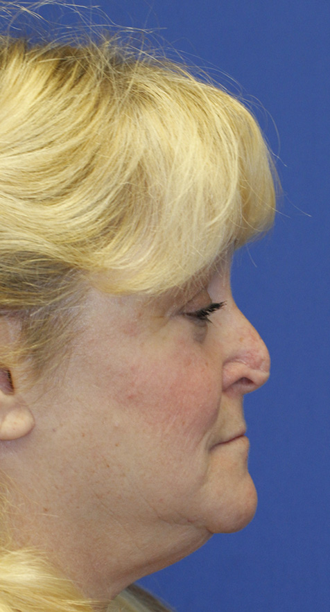 Before Revision Rhinoplasty Profile