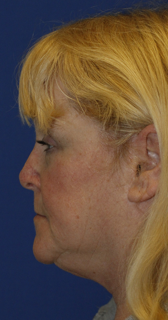 After Revision Rhinoplasty Profile
