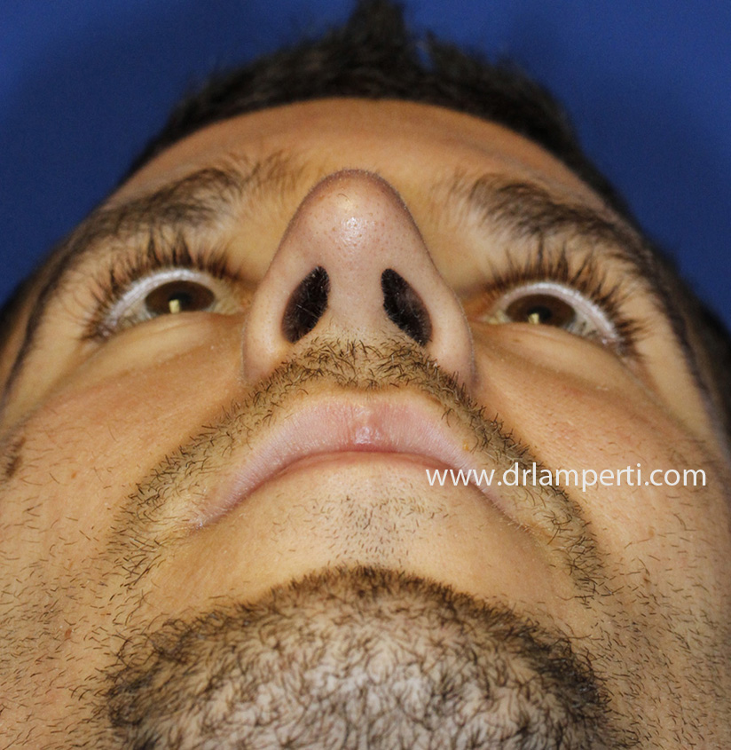Revision Rhinoplasty Base After