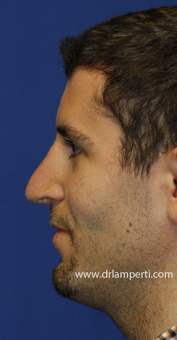 Revision Rhinoplasty Profile After