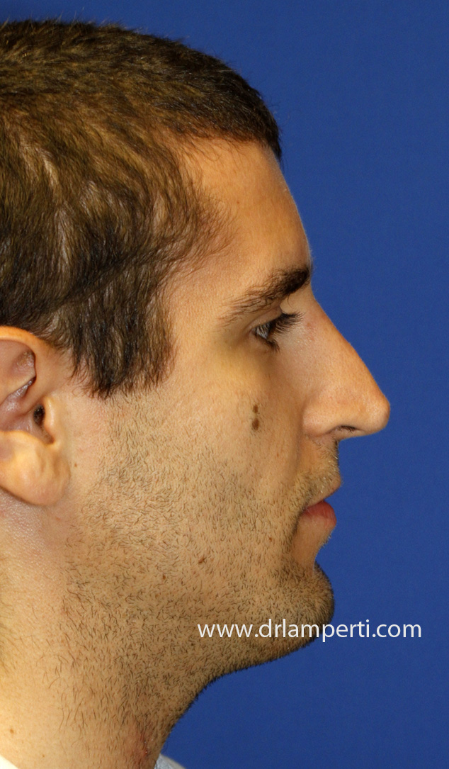 Revision Rhinoplasty Profile Before