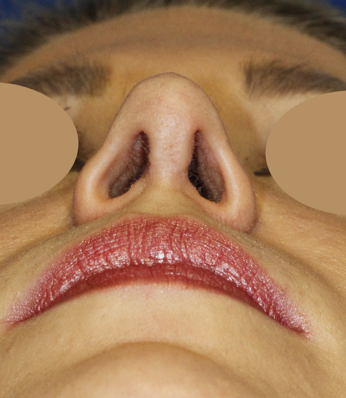 Revision Rhinoplasty AfterBase
