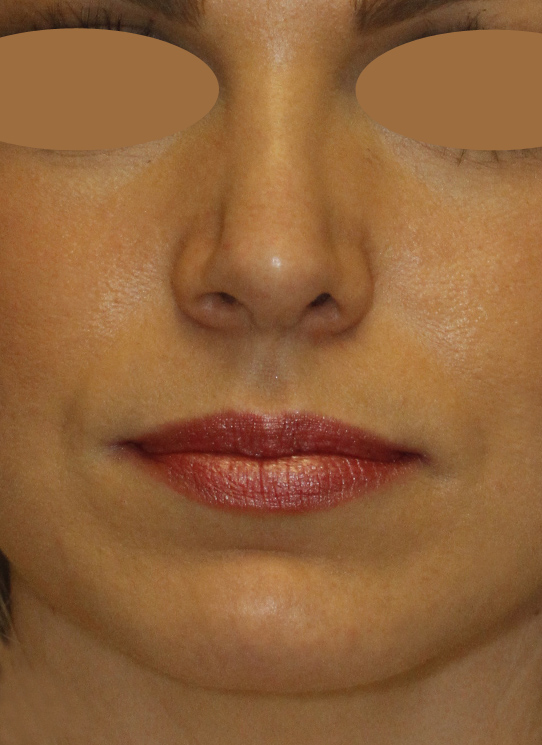 Revision Rhinoplasty After Frontal
