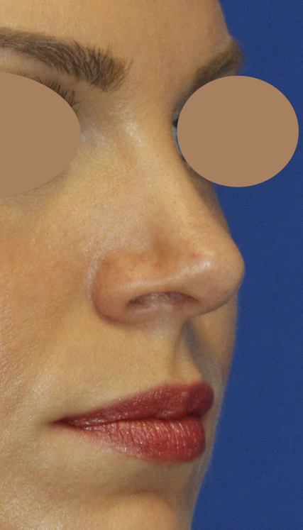 Revision Rhinoplasty After Right Oblique
