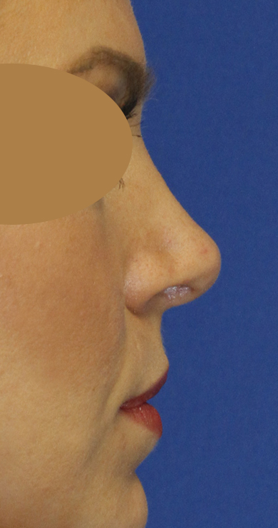 Revision Rhinoplasty After Right Profile