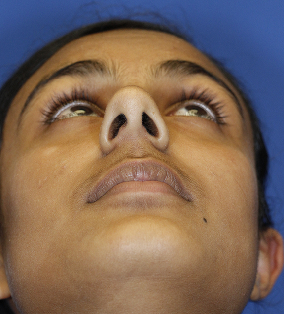 Indian rhinoplasty preop base