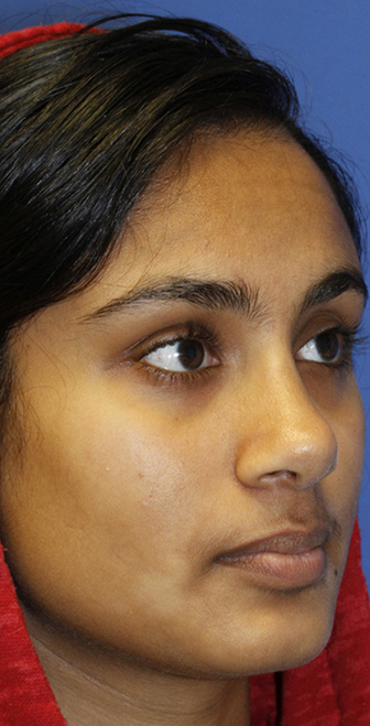 Indian rhinoplasty postop oblique