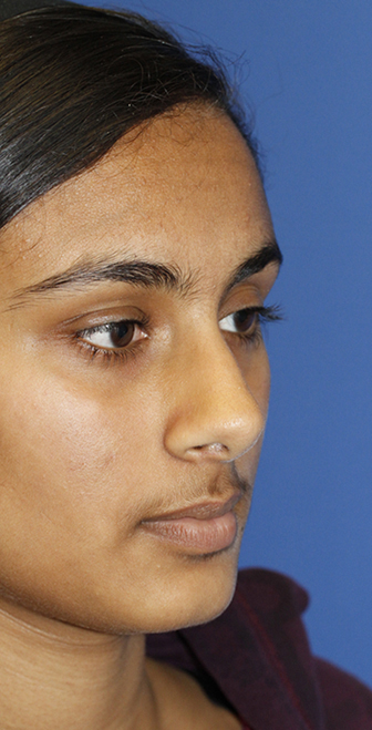 Indian rhinoplasty preop oblique