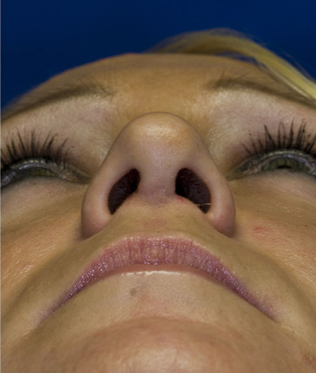 After rhinoplasty photo