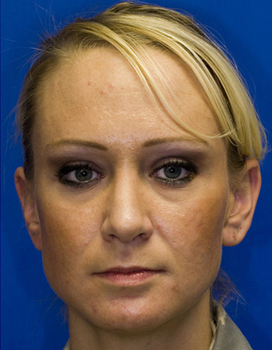 After rhinoplasty photo