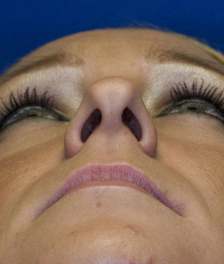 Before rhinoplasty photo