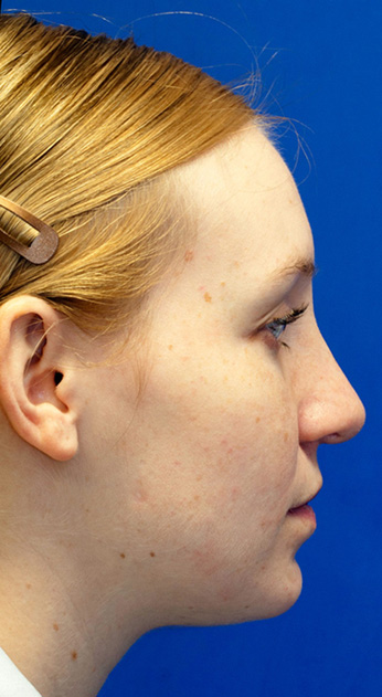 After Rhinoplasty Profile