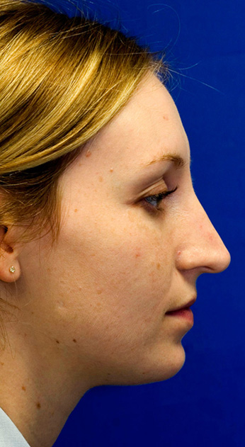 Before Rhinoplasty Profile