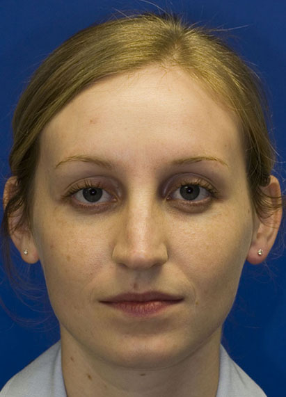 Before Rhinoplasty frontal