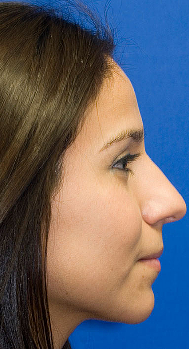 Before Rhinoplasty Frontal