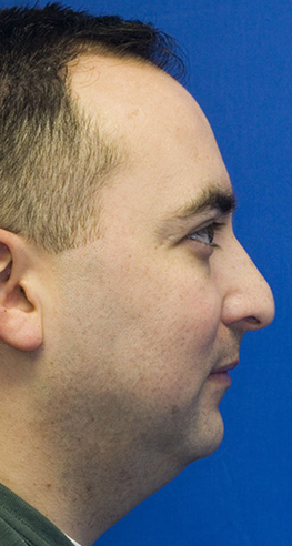 Beofre rhinoplasty profile