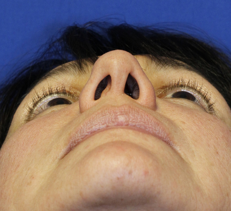 Before rhinoplasty base photo