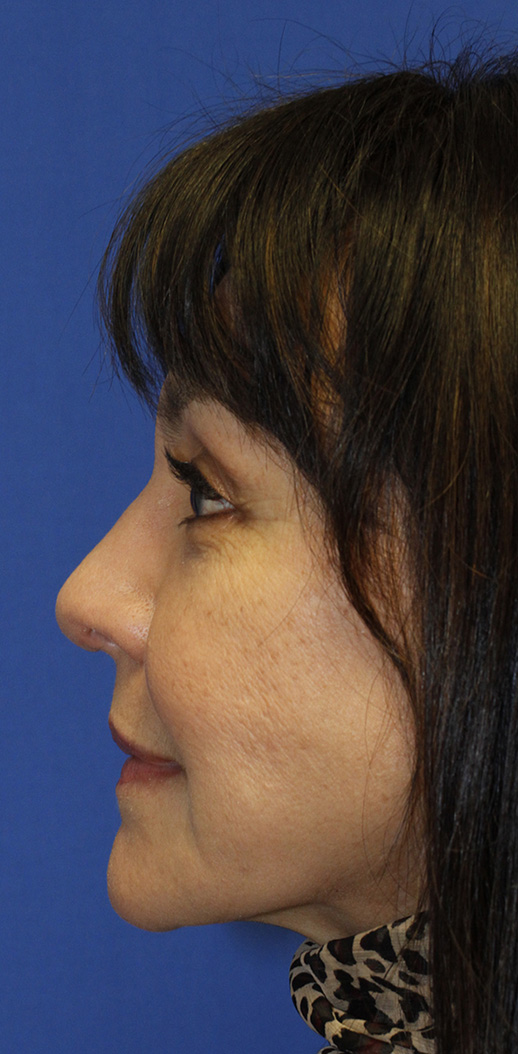 After rhinoplasty profile photo